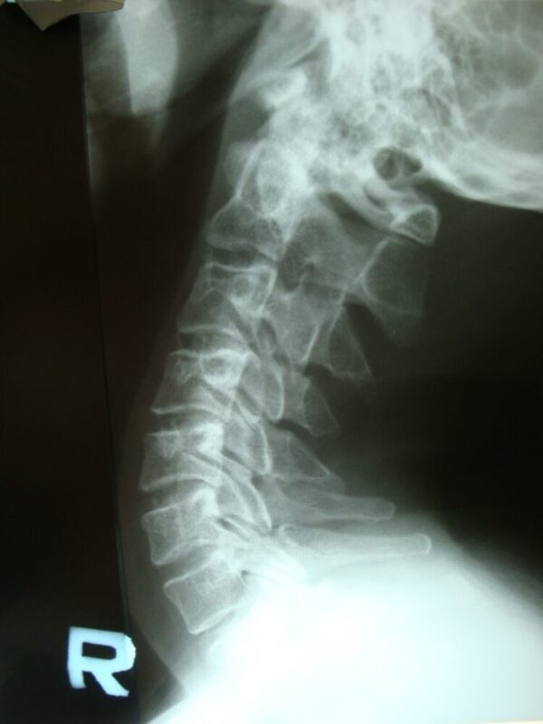 スマホ首のレントゲン